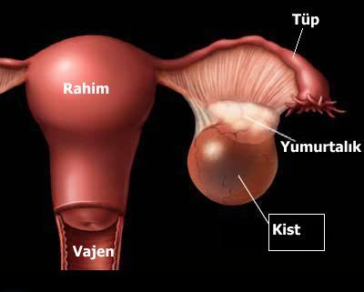 Çikolata Kisti Tedavisi Nasıl Yapılır?