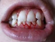 Diş eti kanaması nedir ? Nasıl tedavi edilir ?