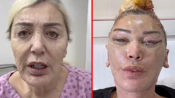 Estetik nedeniyle yüzü deforme olmuştu! Seda Sayan’ın ablası Nursel Sayan’ın son hali ortaya çıktı